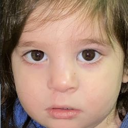 Cleft Lip Before & After Patient #2171