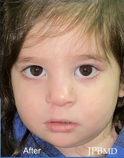 Cleft Lip Before & After Patient #2171
