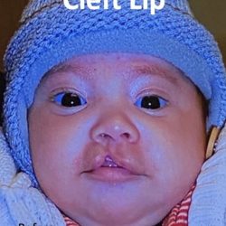 Cleft Lip Before & After Patient #2172
