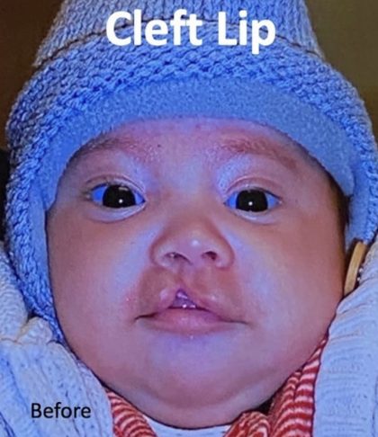 Cleft Lip Before & After Patient #2172