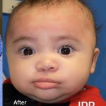 Cleft Lip Before & After Patient #2172