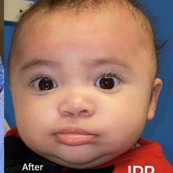 Cleft Lip Before & After Patient #2172