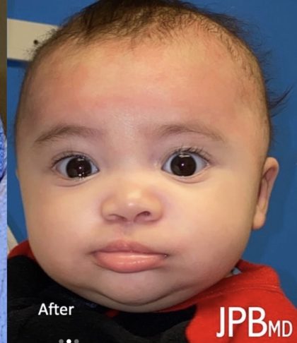 Cleft Lip Before & After Patient #2172