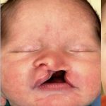 Cleft Lip Before & After Patient #2173