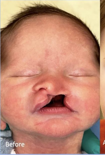 Cleft Lip Before & After Patient #2173