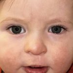 Cleft Lip Before & After Patient #2173