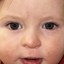 Cleft Lip Before & After Patient #2173