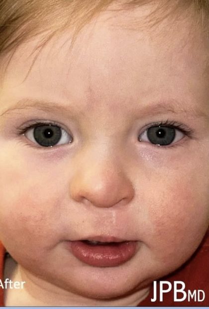 Cleft Lip Before & After Patient #2173