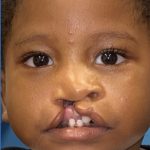 Cleft Lip Before & After Patient #2174