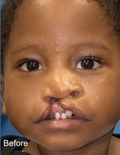 Cleft Lip Before & After Patient #2174