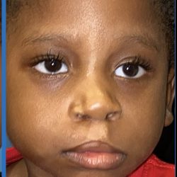 Cleft Lip Before & After Patient #2174