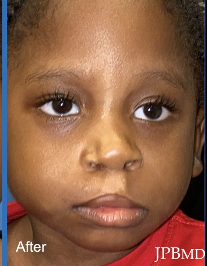 Cleft Lip Before & After Patient #2174