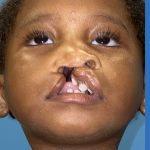 Cleft Lip Before & After Patient #2174