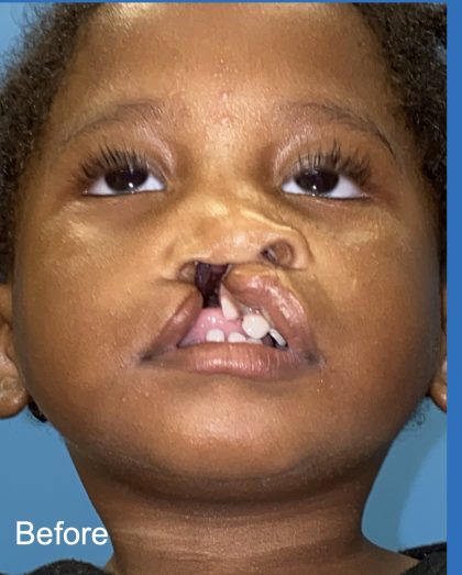 Cleft Lip Before & After Patient #2174