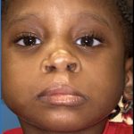 Cleft Lip Before & After Patient #2174