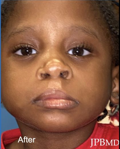 Cleft Lip Before & After Patient #2174