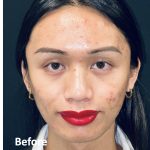 Facial Feminization Before & After Patient #2191
