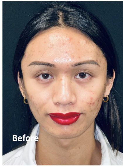 Facial Feminization Before & After Patient #2191