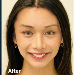 Facial Feminization Before & After Patient #2191