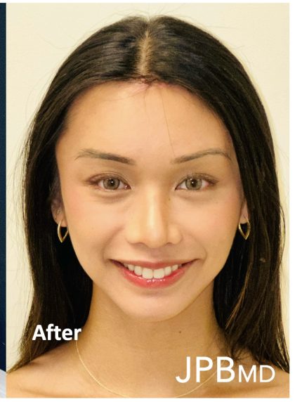 Facial Feminization Before & After Patient #2191