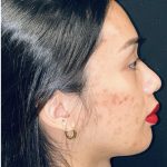 Facial Feminization Before & After Patient #2191