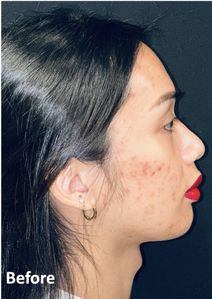 Facial Feminization Before & After Patient #2191