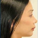 Facial Feminization Before & After Patient #2191