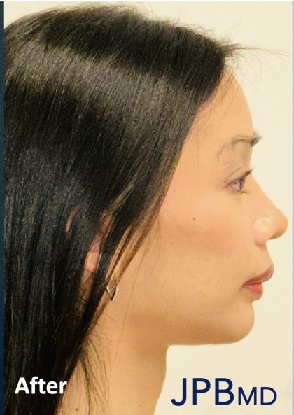 Facial Feminization Before & After Patient #2191
