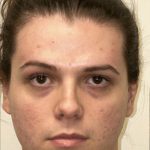 Facial Feminization Before & After Patient #2196