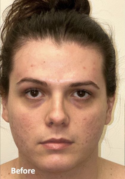Facial Feminization Before & After Patient #2196