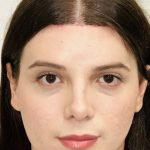 Facial Feminization Before & After Patient #2196