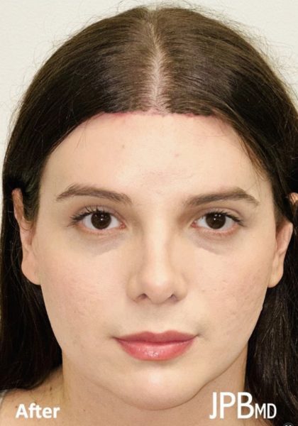 Facial Feminization Before & After Patient #2196