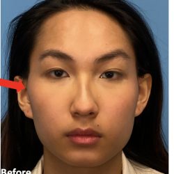 Facial Feminization Before & After Patient #2197