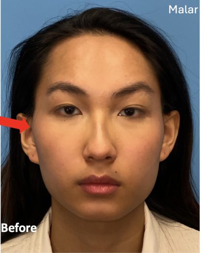 Facial Feminization Before & After Patient #2197