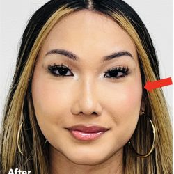 Facial Feminization Before & After Patient #2197