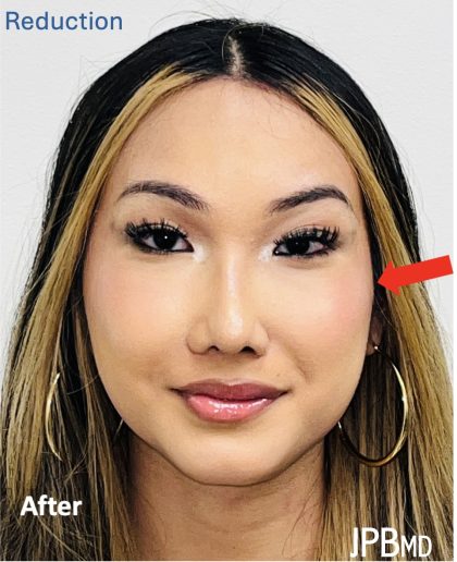 Facial Feminization Before & After Patient #2197