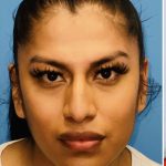 Facial Feminization Before & After Patient #2198