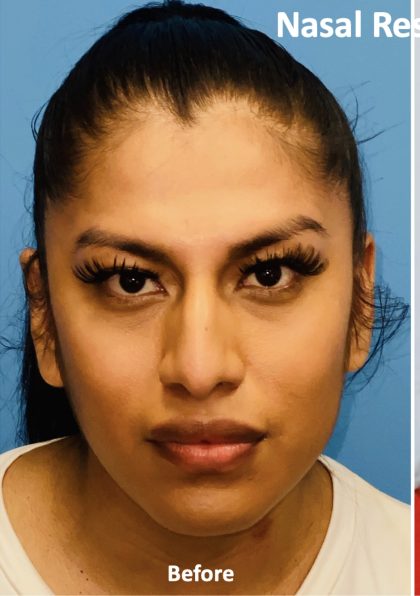 Facial Feminization Before & After Patient #2198