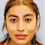 Facial Feminization Before & After Patient #2198