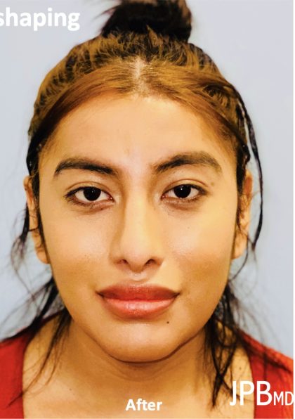 Facial Feminization Before & After Patient #2198