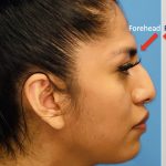 Facial Feminization Before & After Patient #2198