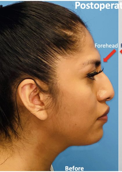 Facial Feminization Before & After Patient #2198
