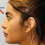 Facial Feminization Before & After Patient #2198