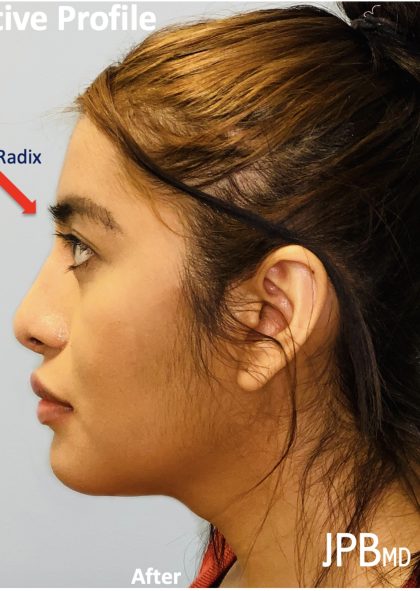 Facial Feminization Before & After Patient #2198
