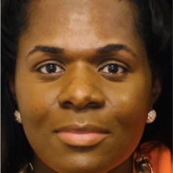 Facial Feminization Before & After Patient #2199