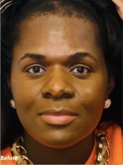 Facial Feminization Before & After Patient #2199