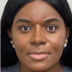 Facial Feminization Before & After Patient #2199