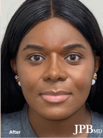 Facial Feminization Before & After Patient #2199
