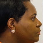 Facial Feminization Before & After Patient #2199