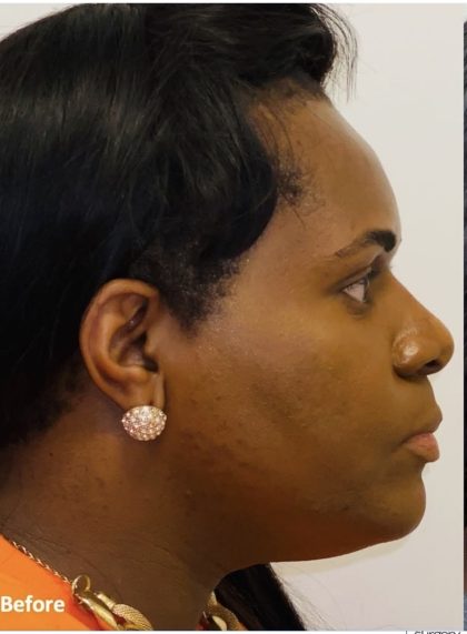 Facial Feminization Before & After Patient #2199